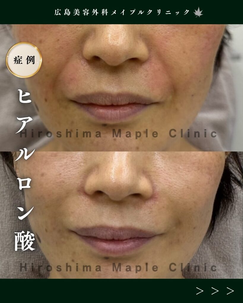 ヒアルロン酸注入