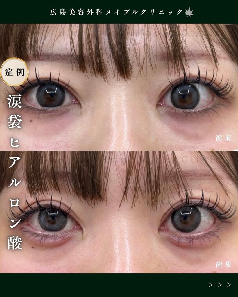 涙袋ヒアルロン