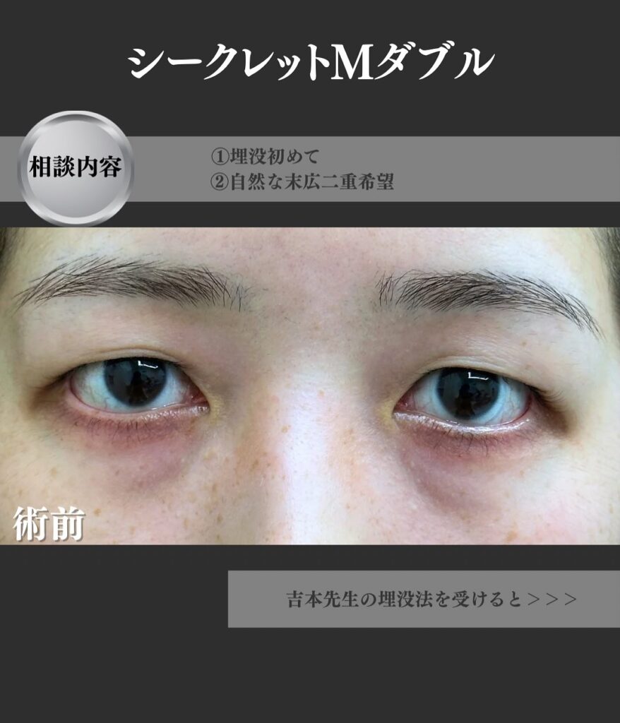 シークレットMダブル